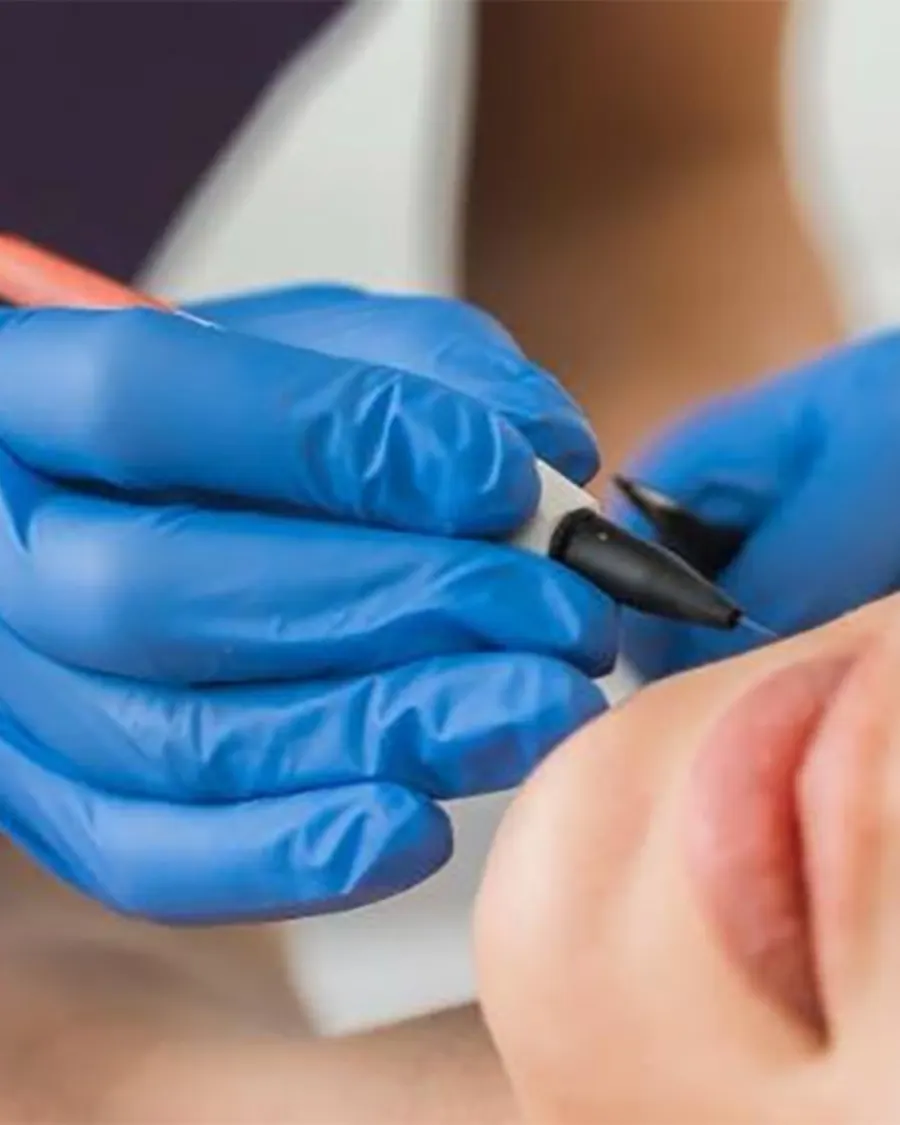 Advanced Permanent Hair Removal at Cinch Clinics