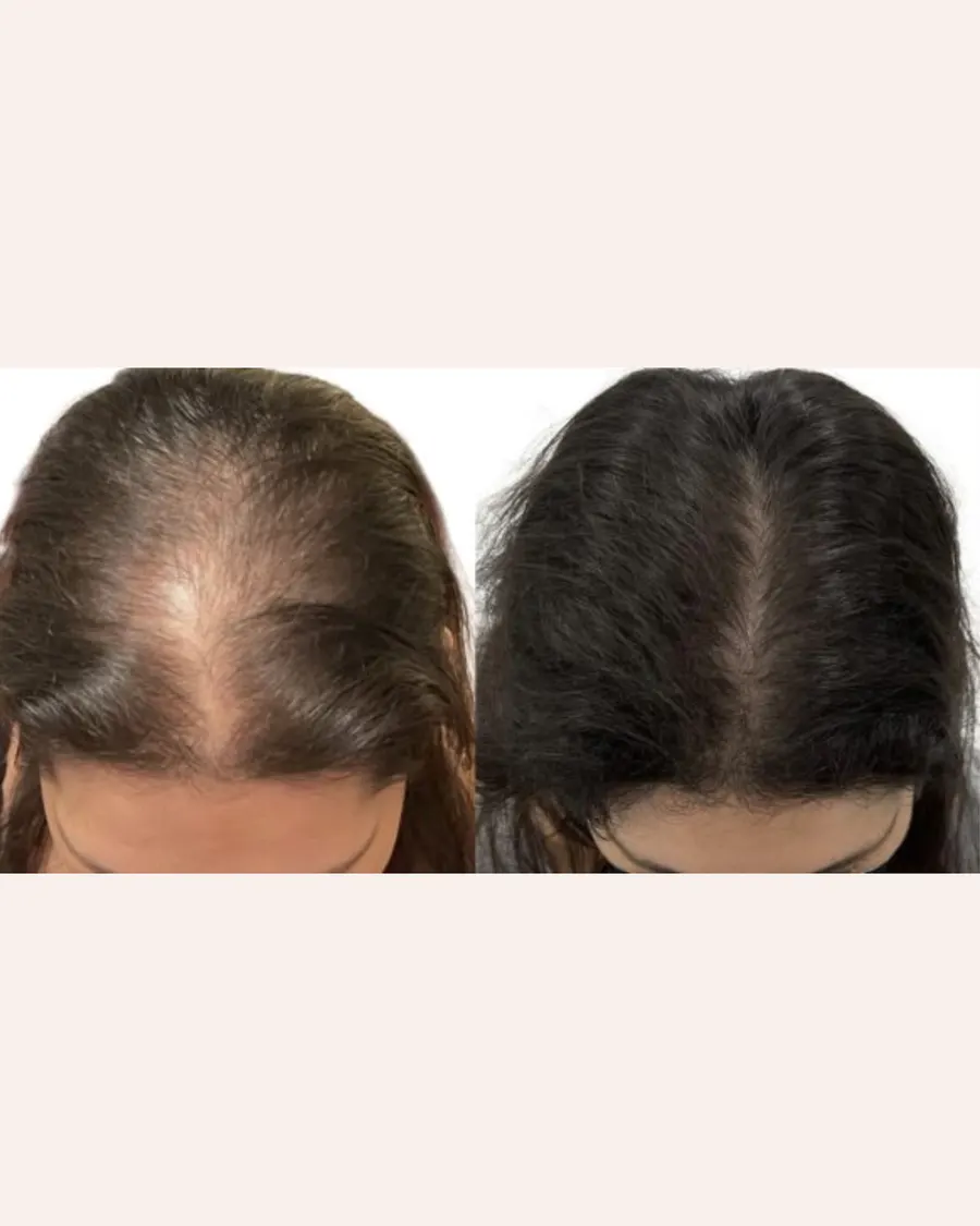 Advanced Hair Regeneration with Exosomes at Cinch Clinics