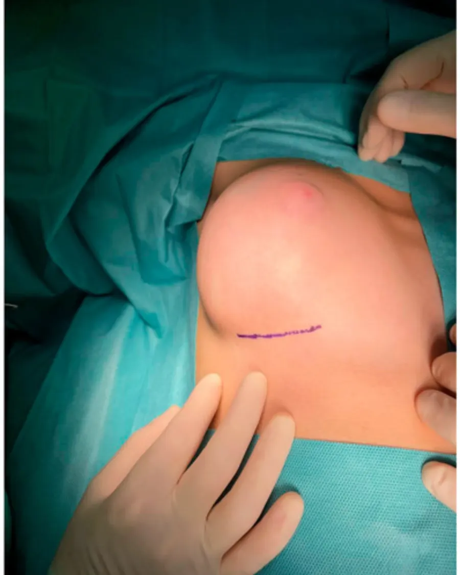 Fibroadenoma at Cinch Clinics