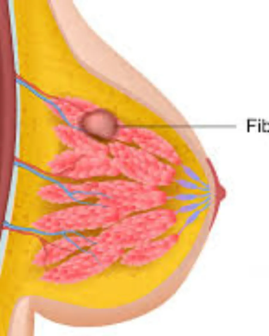 Fibroadenosis at Cinch Clinics