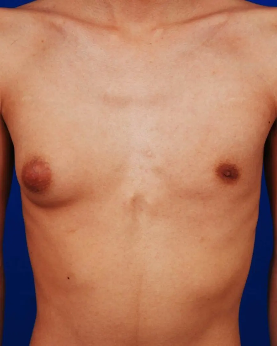 Gynecomastia at Cinch Clinics