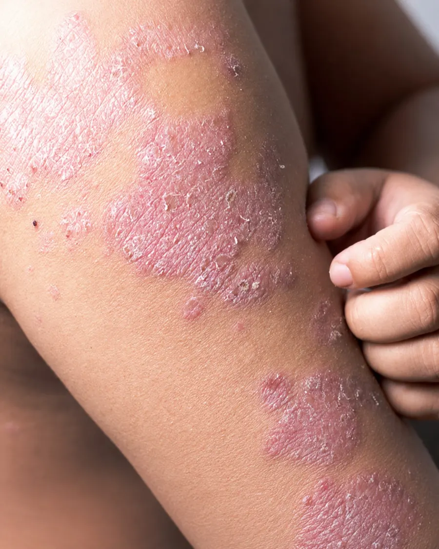 Eczema & atopic dermatitis at Cinch Clinics