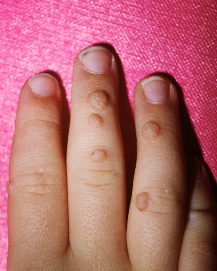 Warts at Cinch Clinics